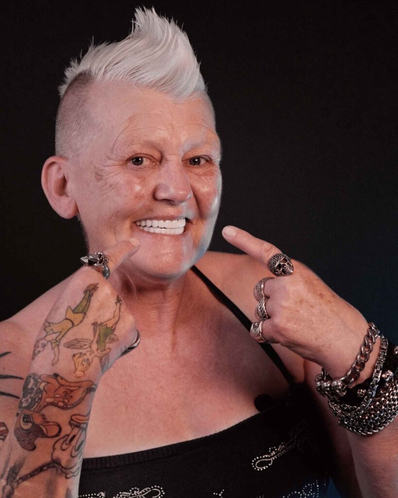 emax laminate veneers