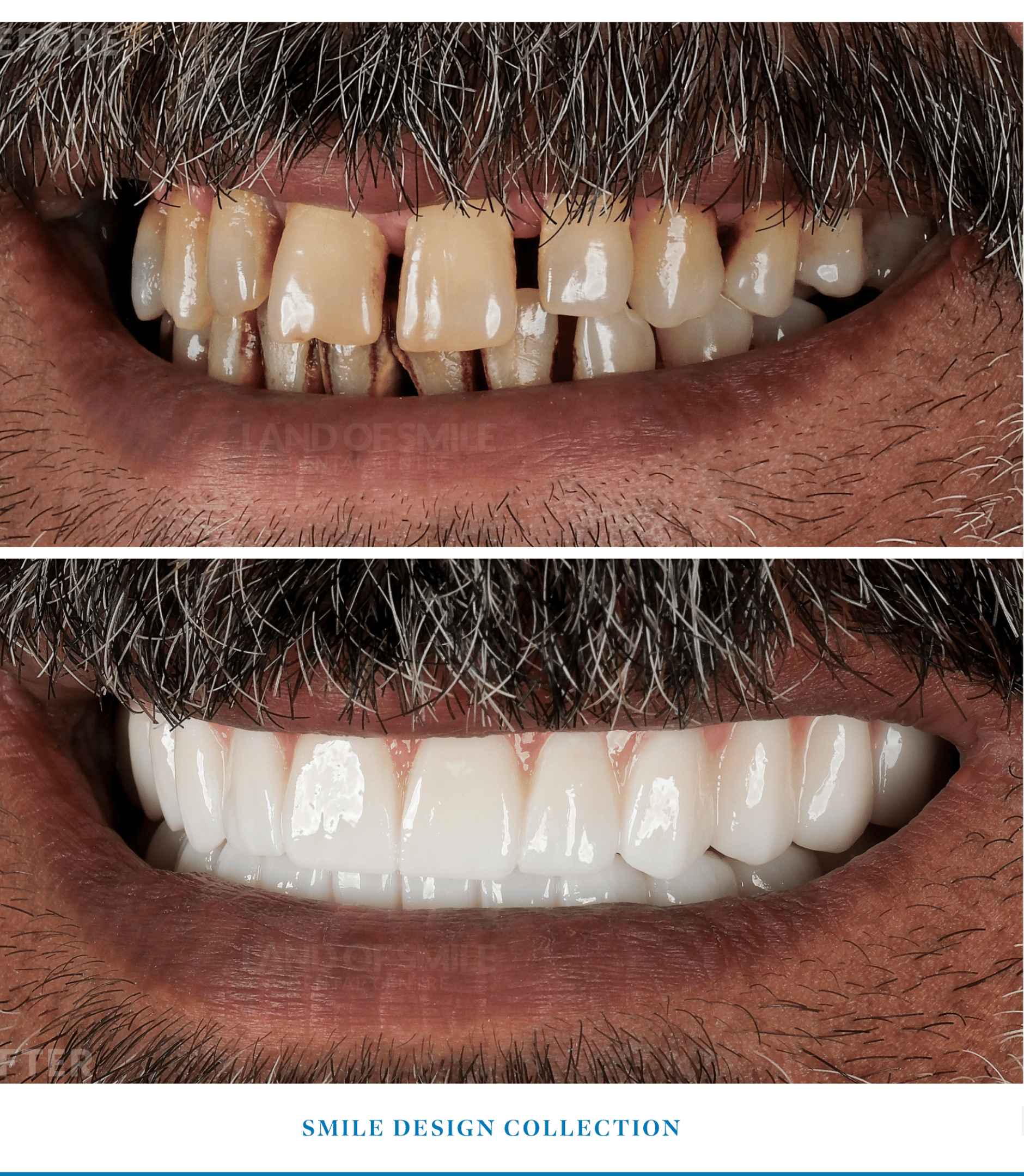 emax laminate veneers