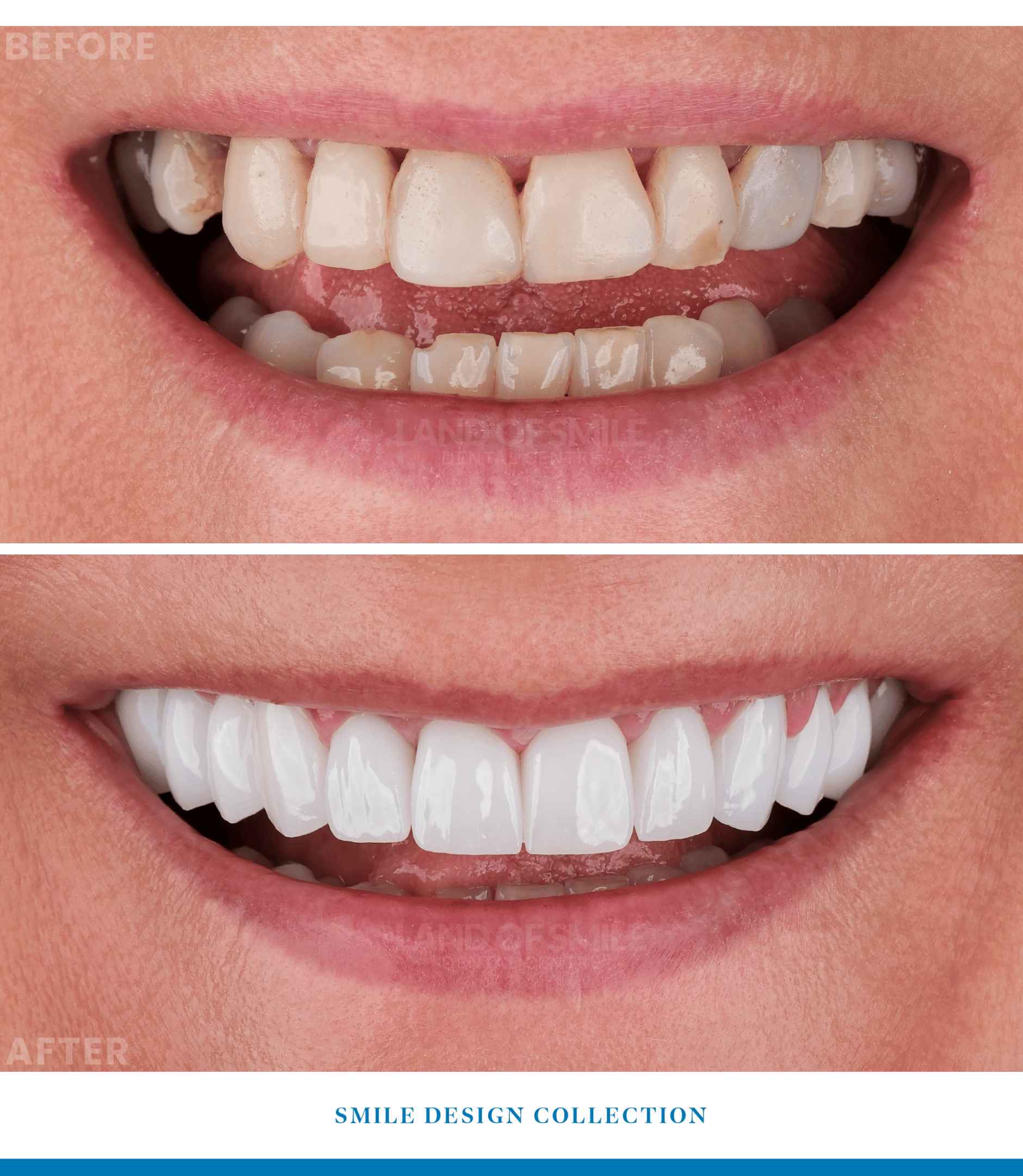 emax laminate veneers