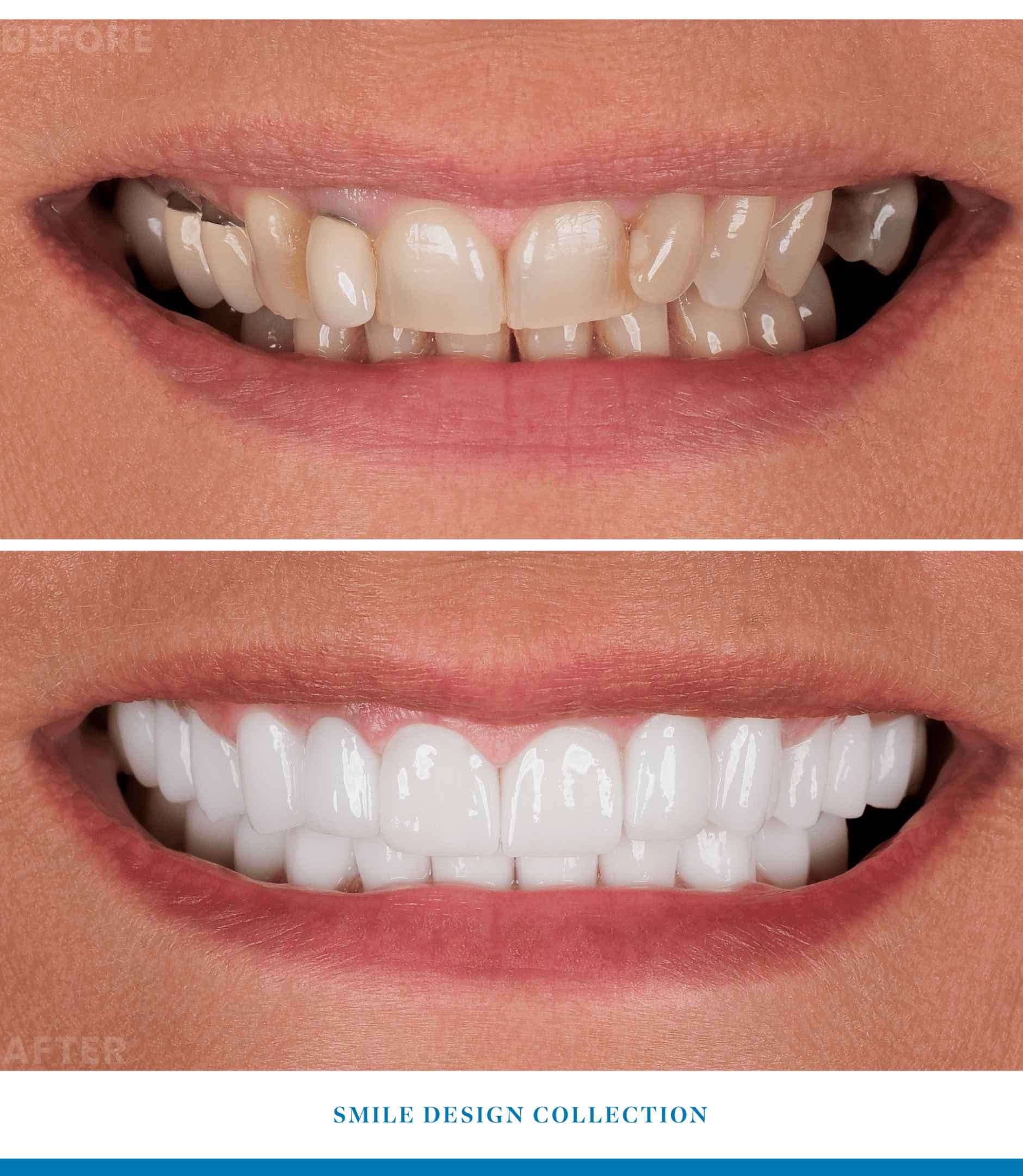emax laminate veneers