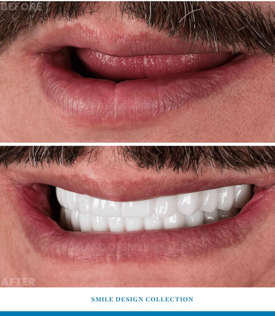 implant before after