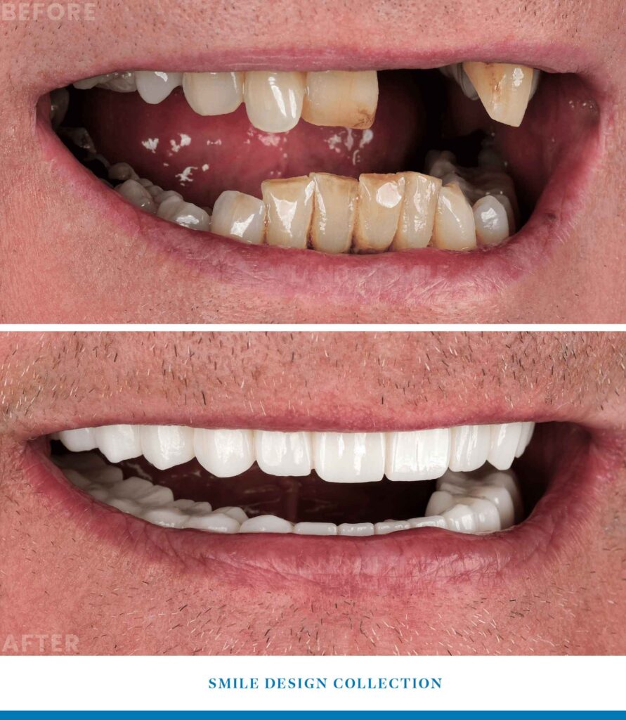 implant before after