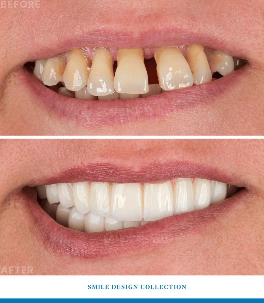 implant before after