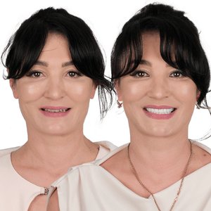 implant before after