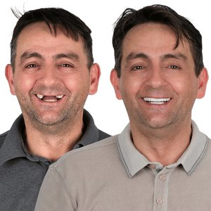 implant before after