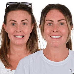 implant before after