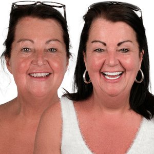 implant before after