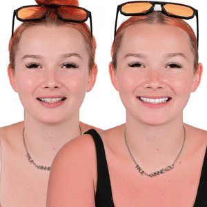 implant before after