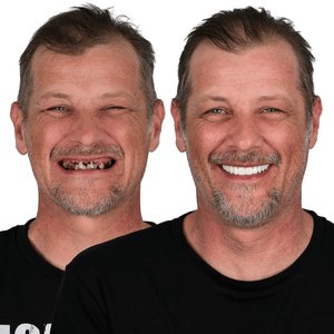 implant before after