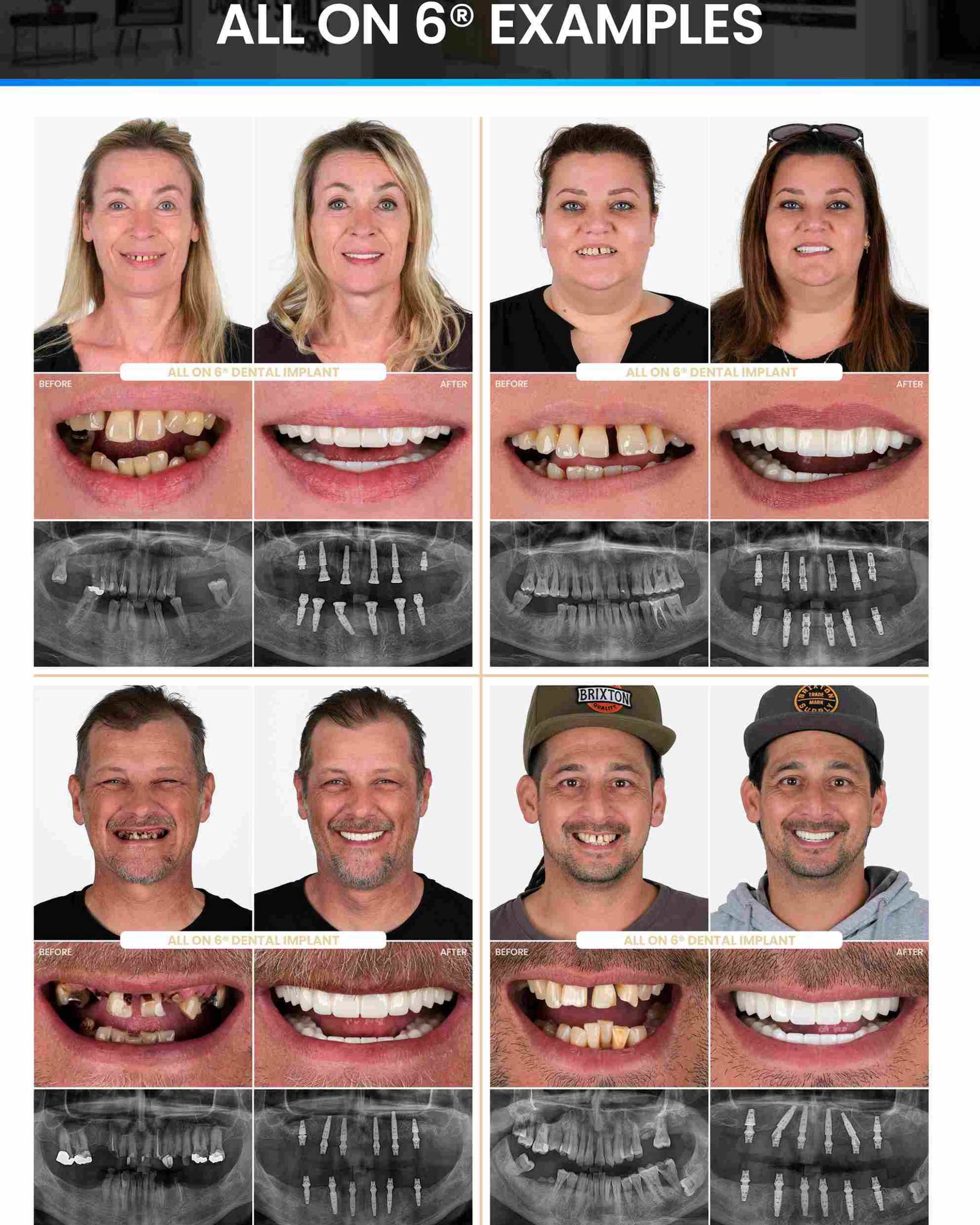 All-on-6 Dental Implants
