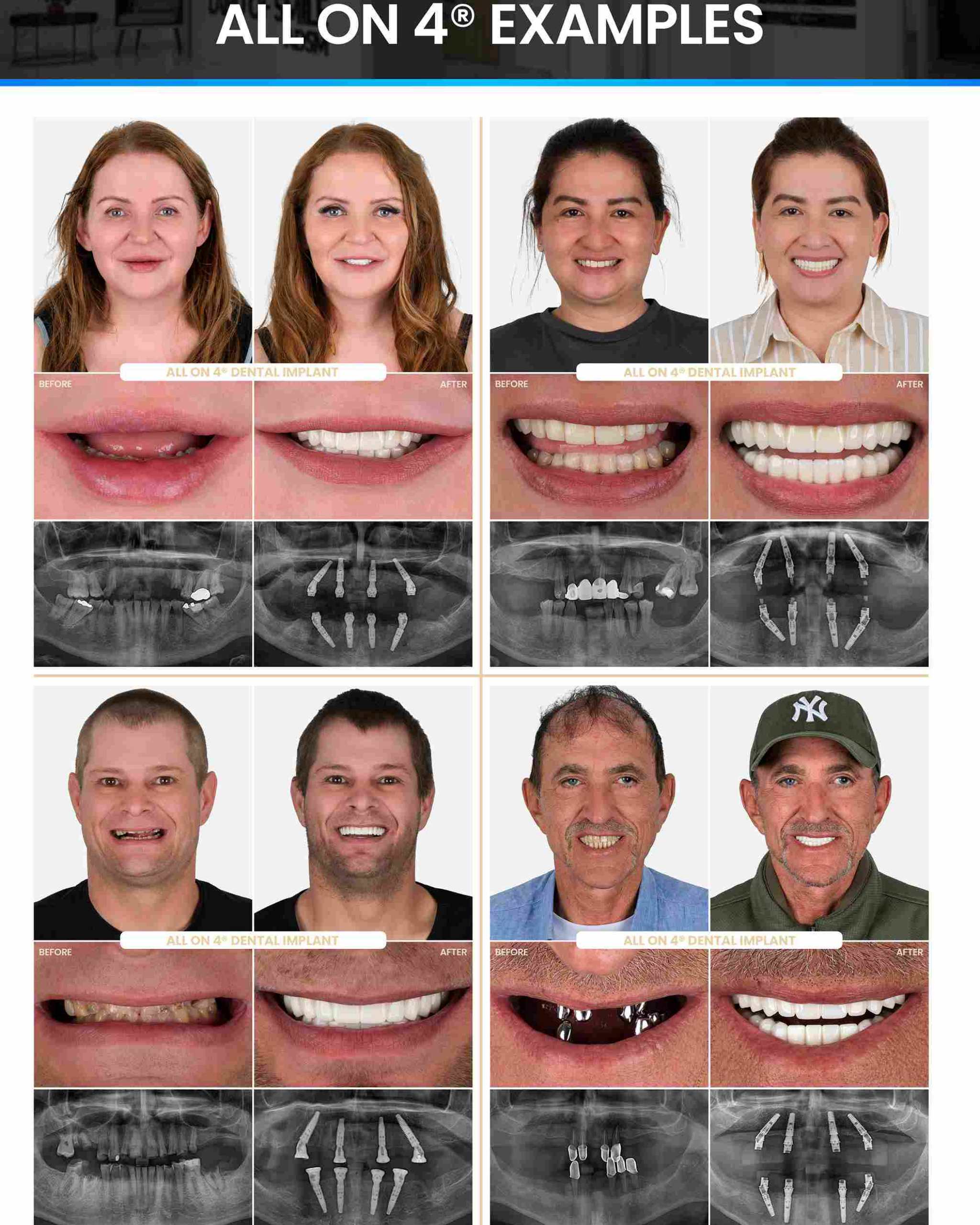 All-on-4 Dental Implants