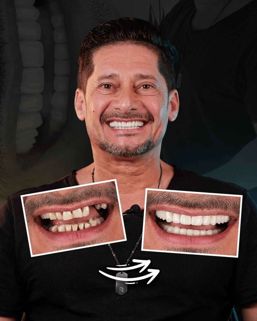 All-on-6 Dental Implants
