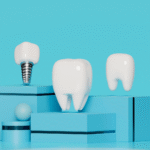 All-on-4 Dental Implants