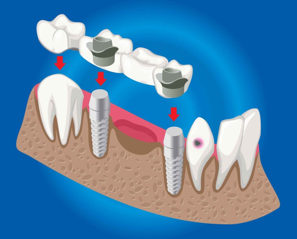 Is It Worth Going to Turkey for Dental Implants