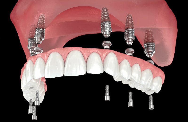 All-on-6 Dental Implants