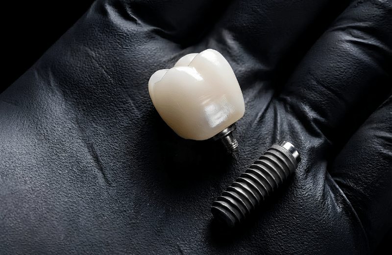 Dental Implants