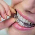 Clear Aligner Braces