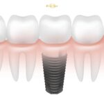Dental Implants Cost in Turkey vs Lithuania