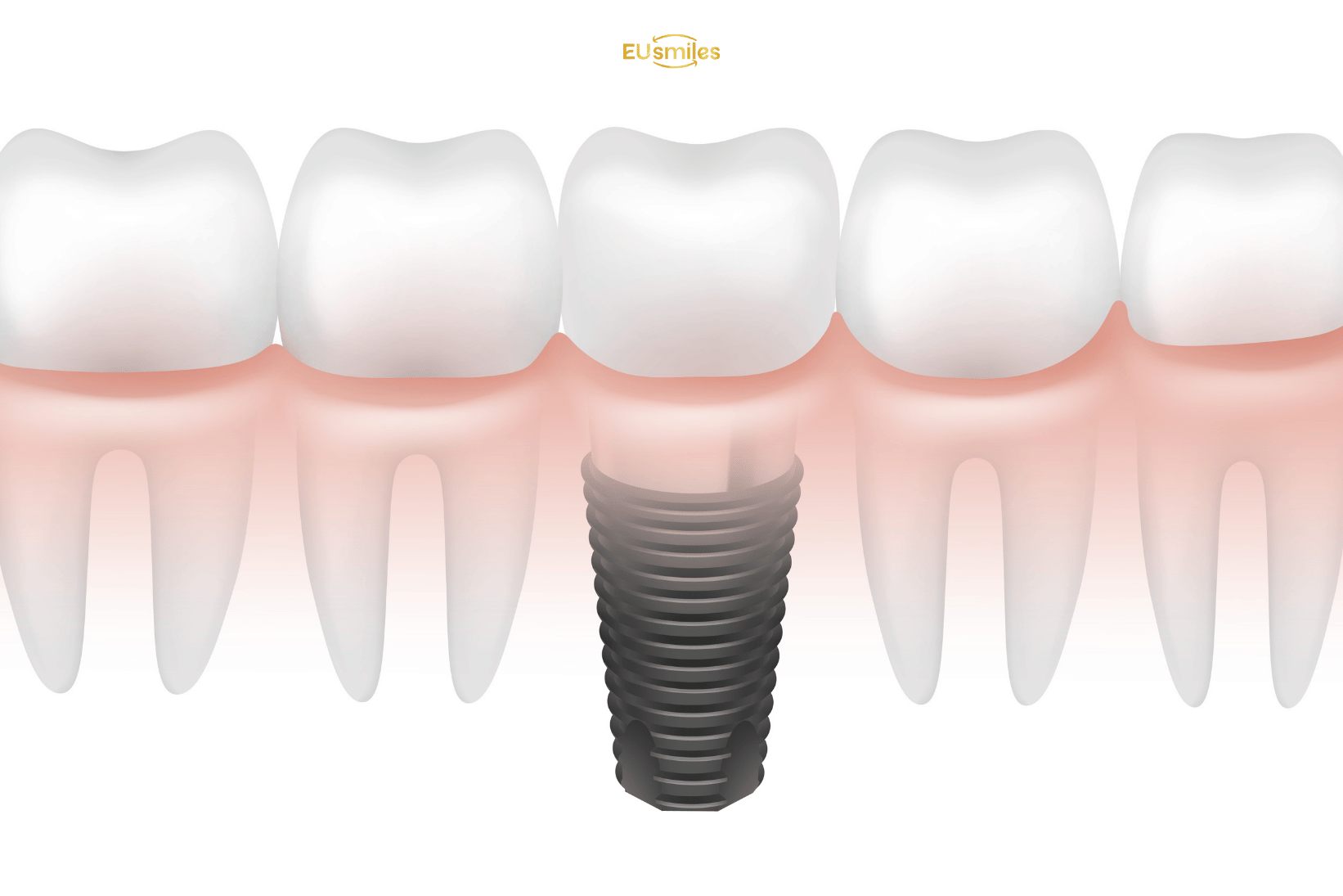 Dental Implants Cost in Turkey vs Lithuania