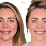 Результаты преображения улыбки «до и после» для пациентов из Литвы