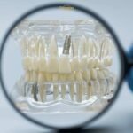 Турция и циркониевые коронки: сравнение для эстонцев