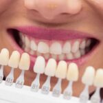 Veneers in Turkey
