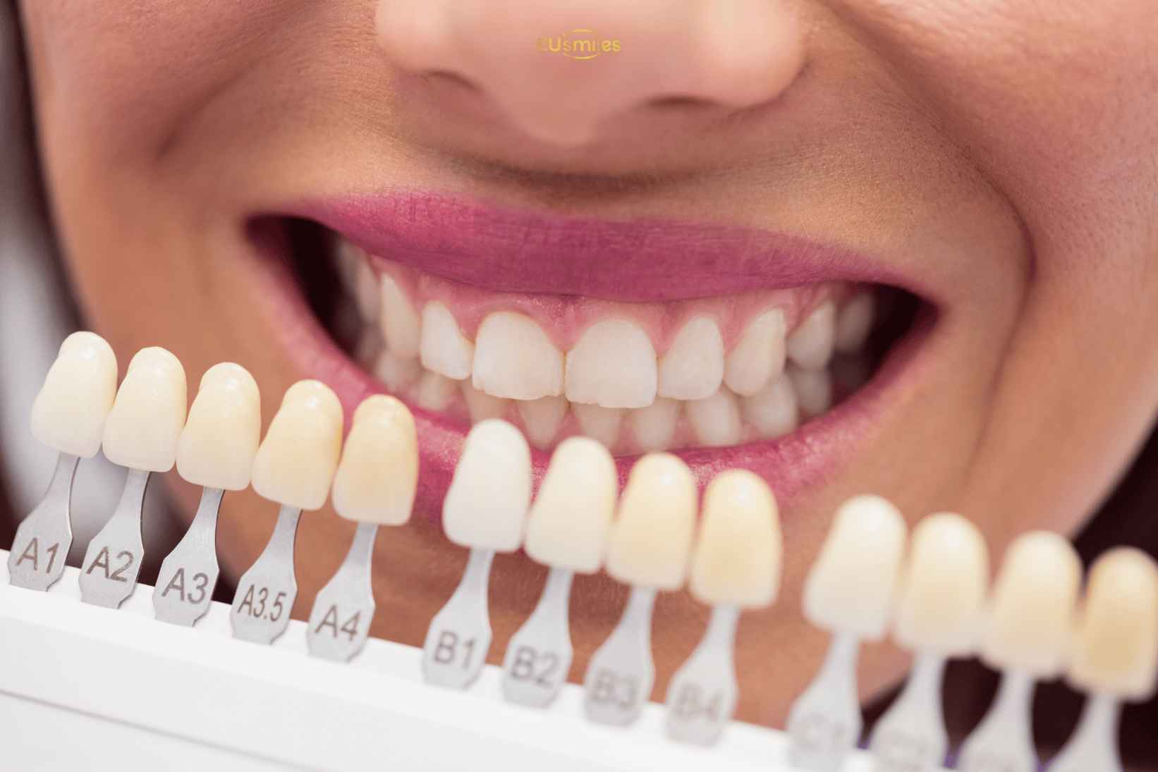Veneers in Turkey