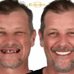 Why Latvian Patients Prefer Dental Treatment in Turkey