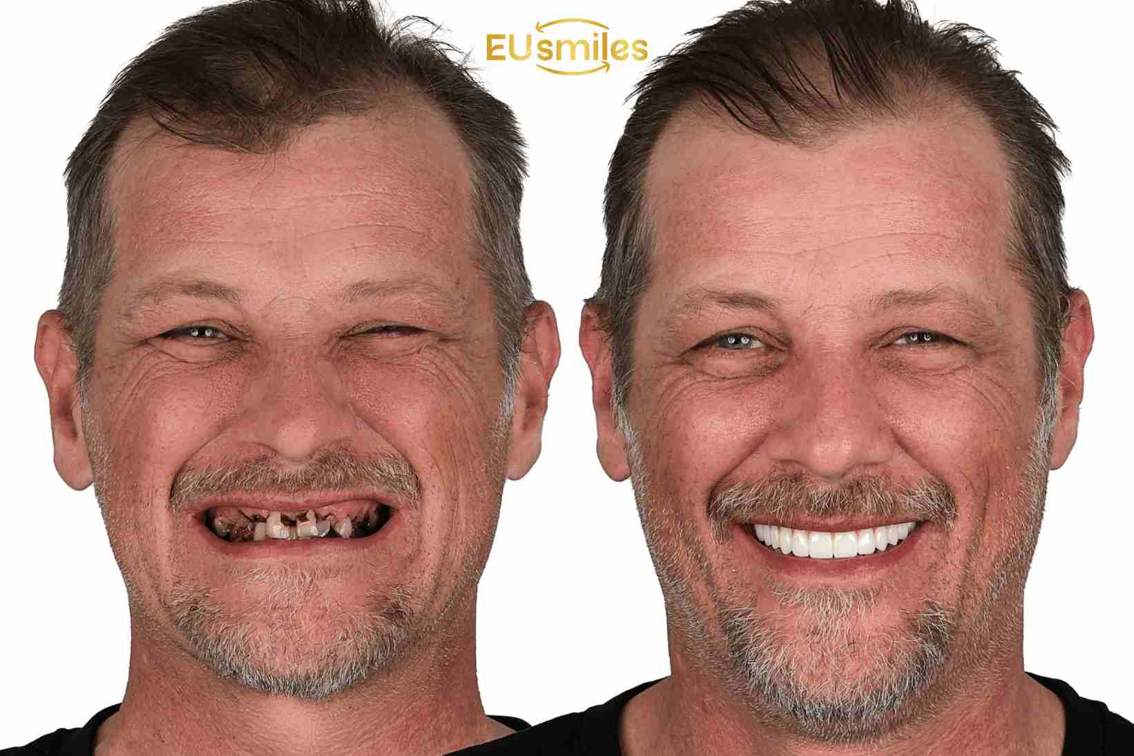 Why Latvian Patients Prefer Dental Treatment in Turkey