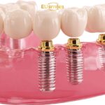 All-on-6 Dental Implants for Patients from Latvia
