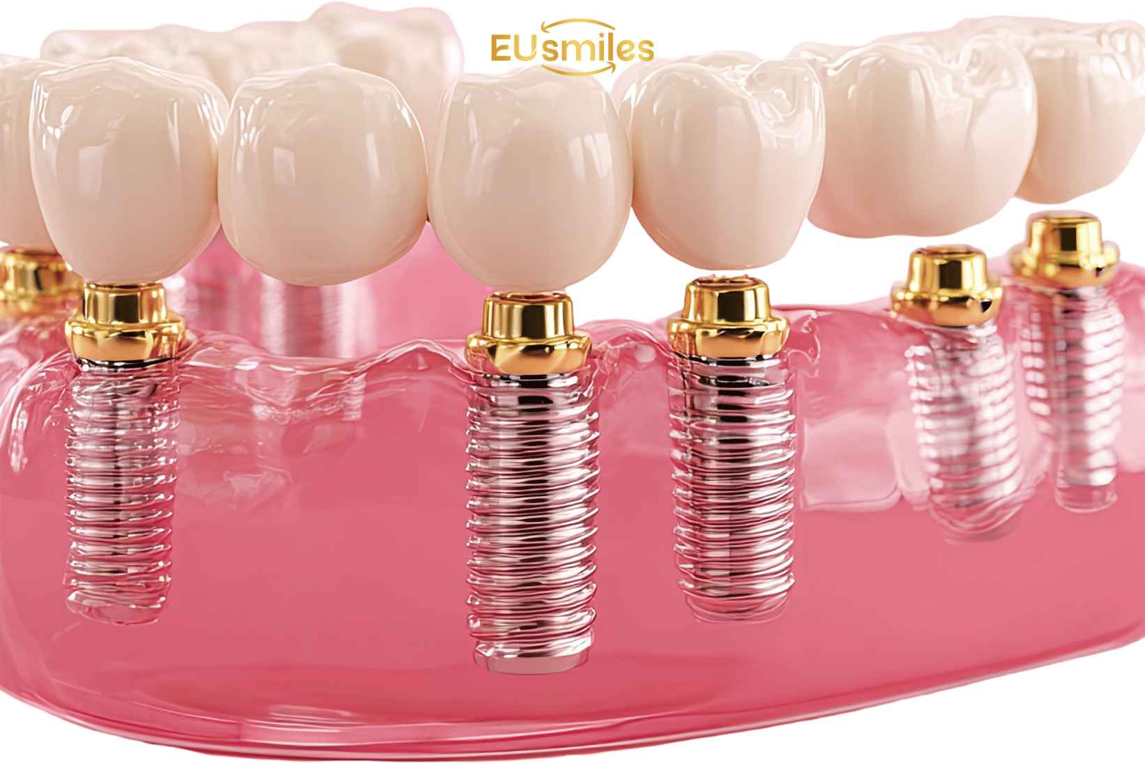 All-on-6 Dental Implants for Patients from Latvia