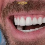 Before & After Dental Implant Results for Latvian Patients