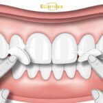 Best Veneer Dentists in Turkey for Foreigners