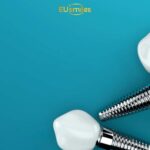 Зубные импланты All-on-4 для пациентов из Эстонии