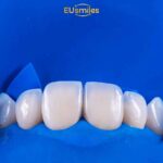 Emax Laminate Veneers Turkey Cost Per Tooth