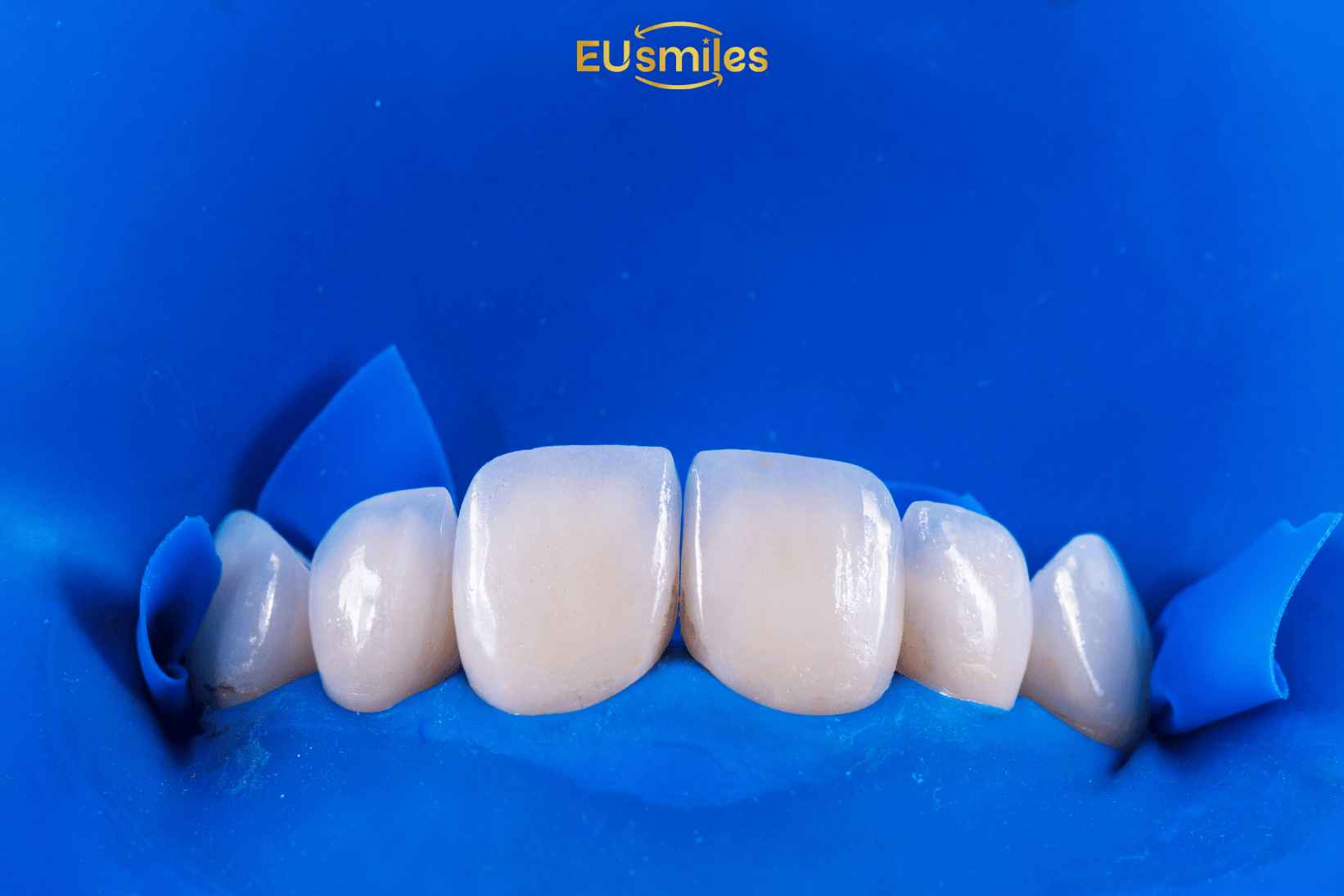 Emax Laminate Veneers Turkey Cost Per Tooth