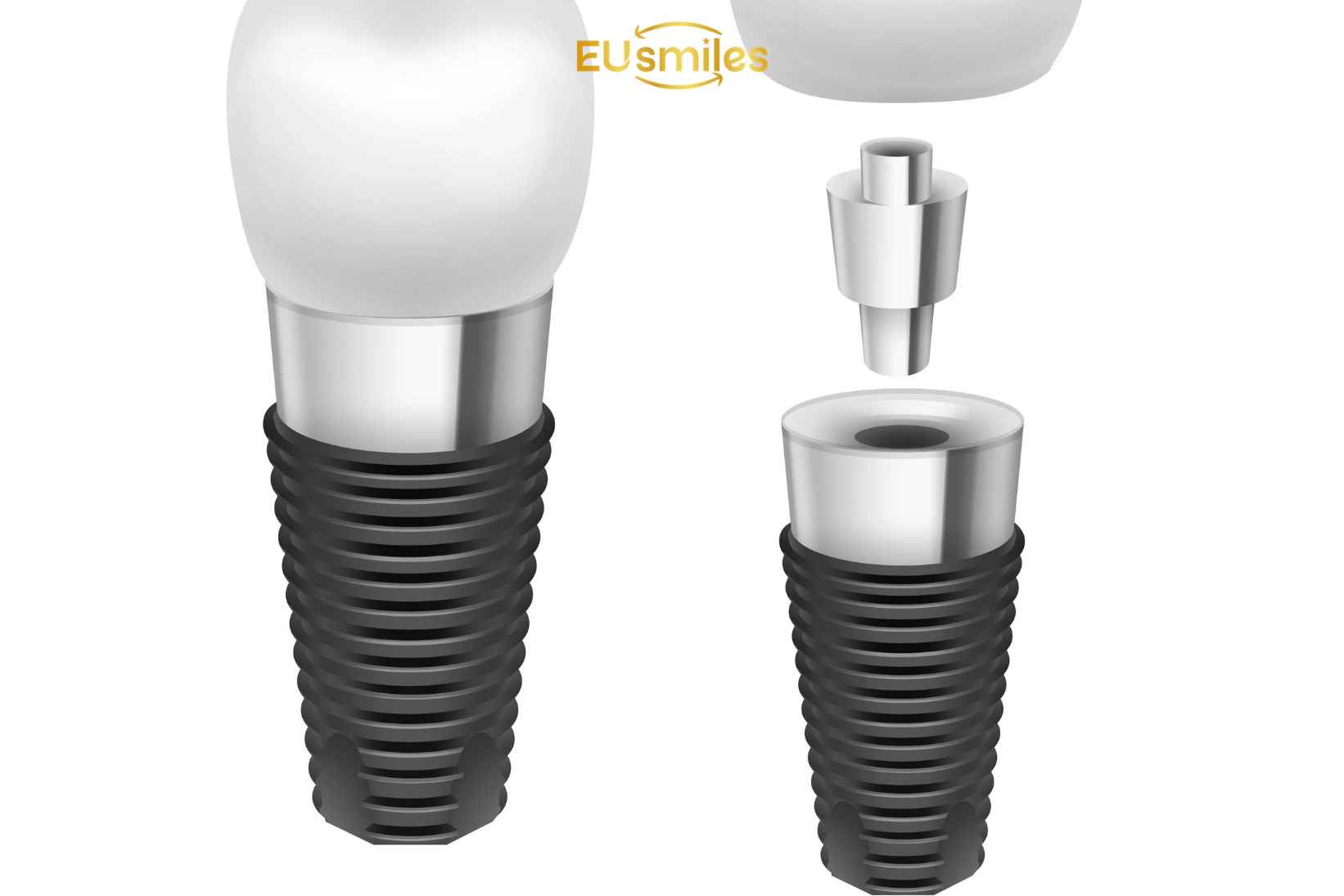 Straumann Implants Price
