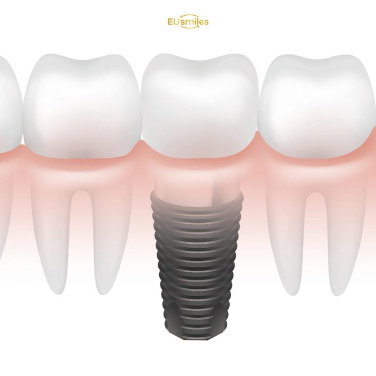 Dental Implants Cost in Turkey vs Lithuania