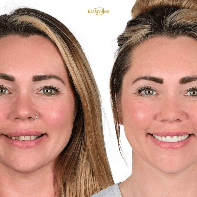 Результаты преображения улыбки «до и после» для пациентов из Литвы