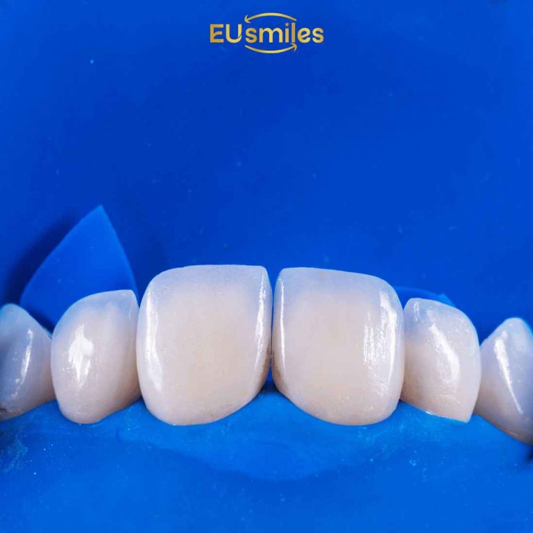 Emax Laminate Veneers Turkey Cost Per Tooth
