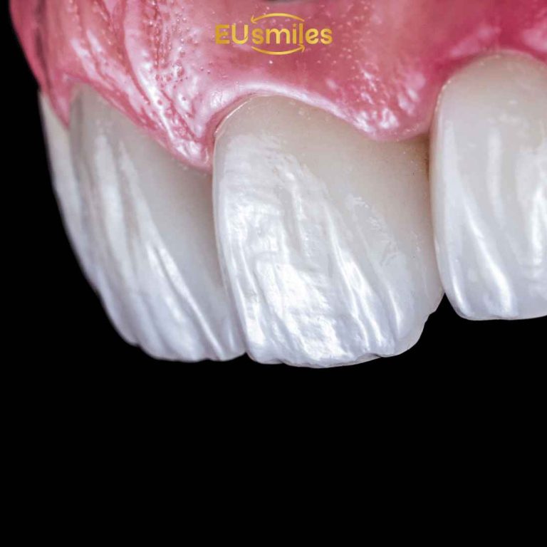 Same Day Veneers Turkey