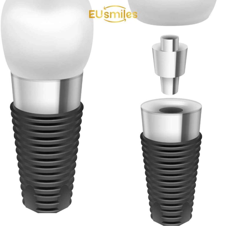 Straumann Implants Price