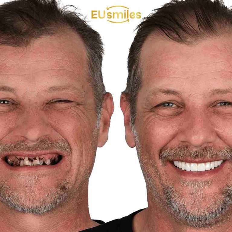 Why Latvian Patients Prefer Dental Treatment in Turkey