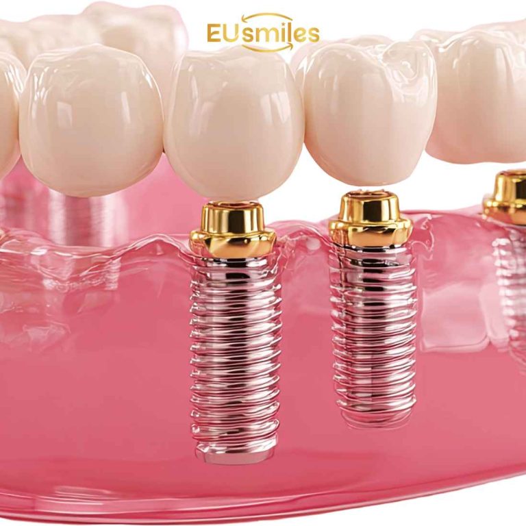 All-on-6 Dental Implants for Patients from Latvia