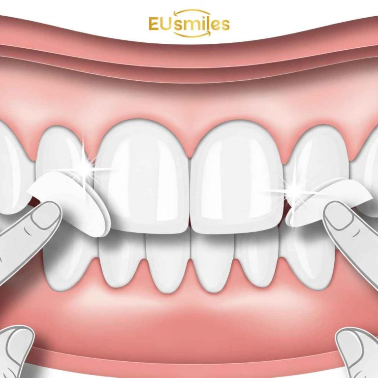 Best Veneer Dentists in Turkey for Foreigners