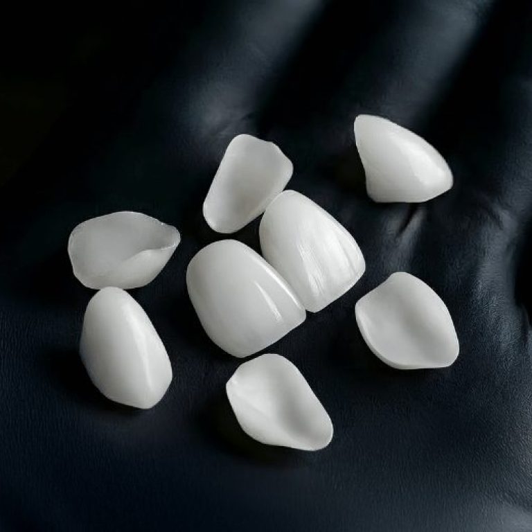 Emax Laminate Veneers